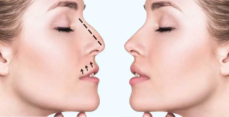 Rinoplastia - Cirugía estética nasal