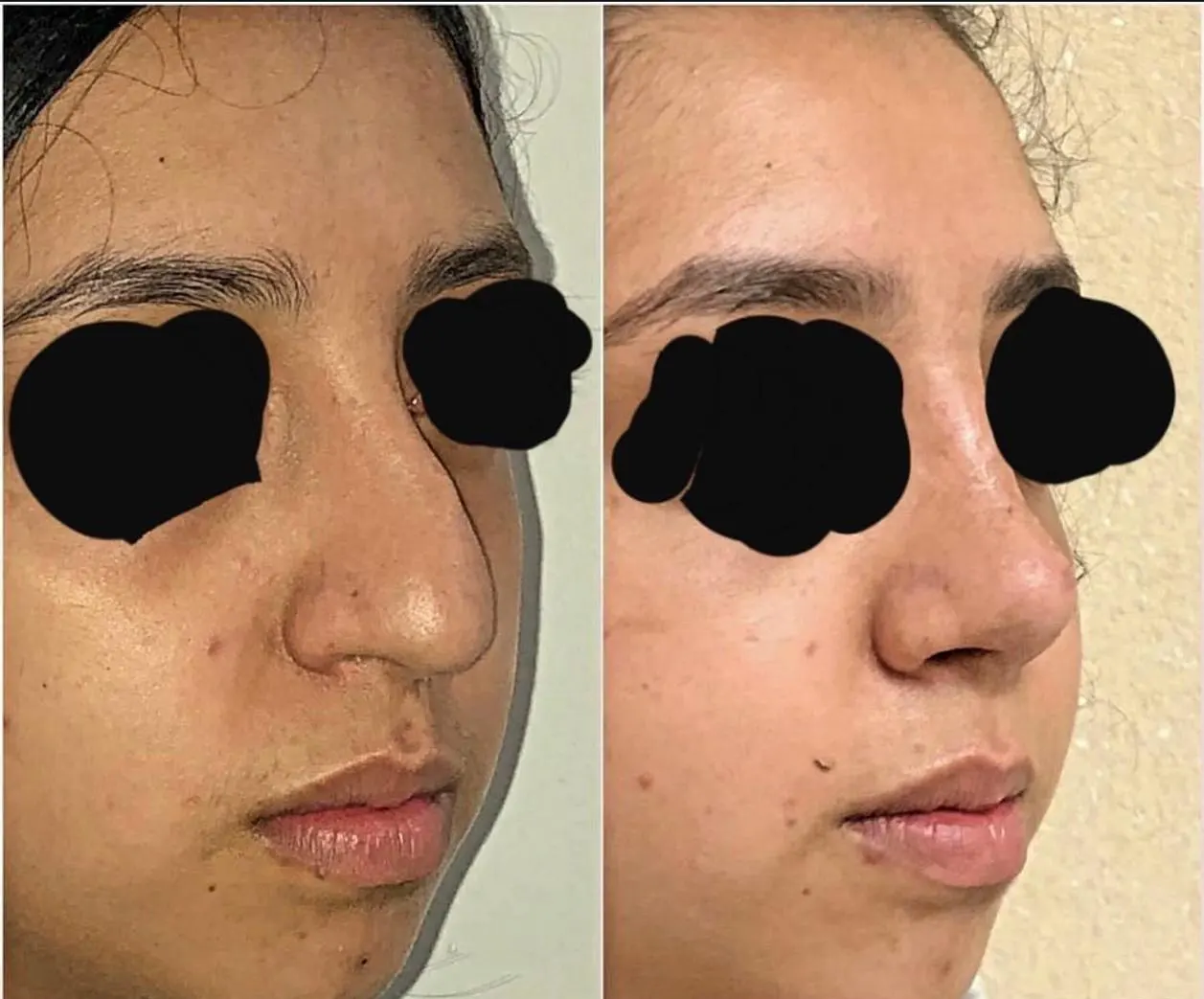 Procedimiento ORL 11 - Caso exitoso