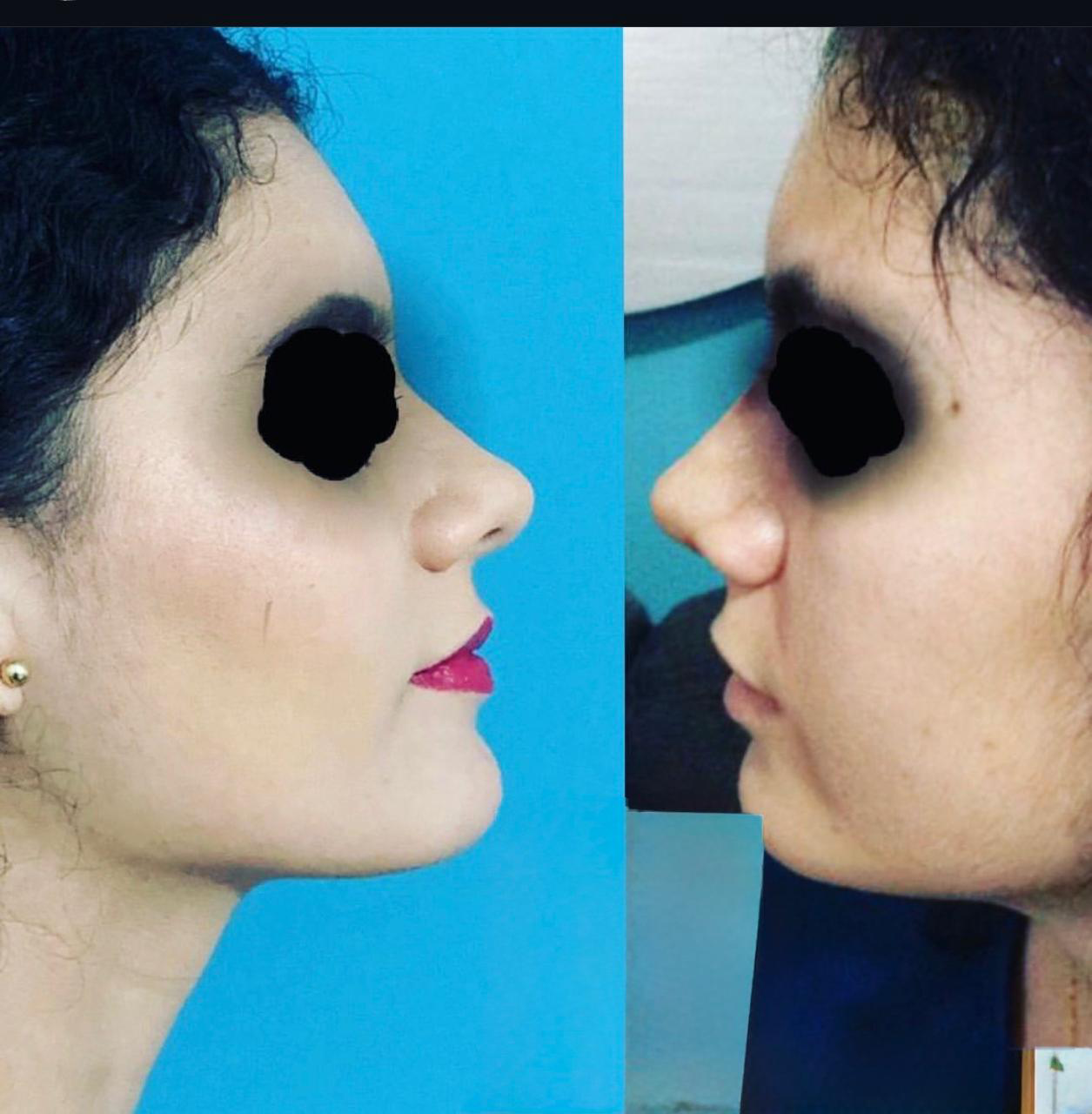 Procedimiento ORL 2 - Caso exitoso