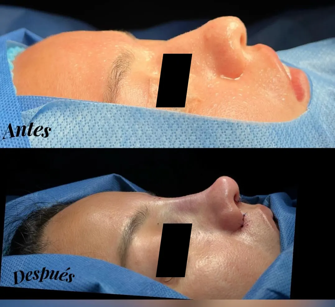 Procedimiento ORL 7 - Caso exitoso